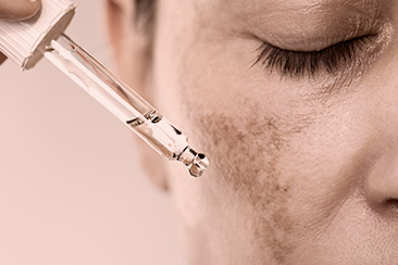 tratamiento de melasma en Uruguay