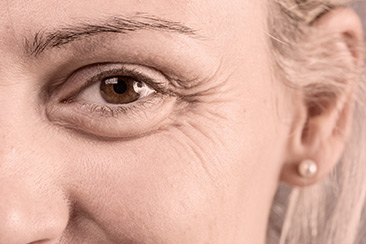 tratamiento de arrugas en Uruguay