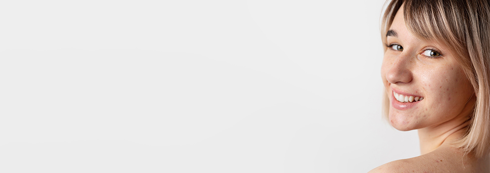 ¿Se puede eliminar el melasma definitivamente?